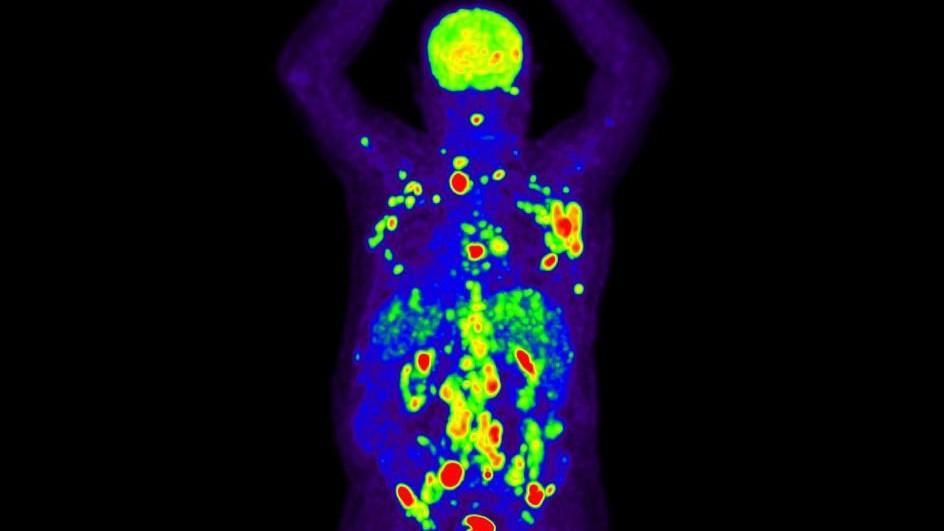 Eliminating cancer with nivolumab and the chemotherapy regimen AVD – NCI