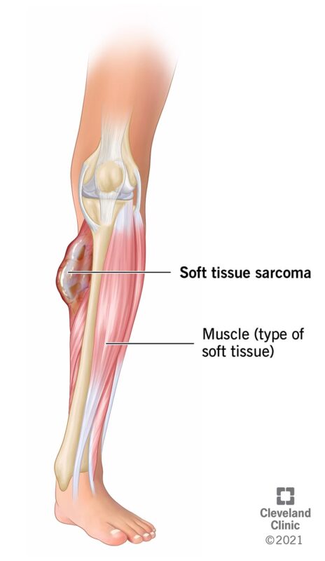 Soft Tissue Sarcoma