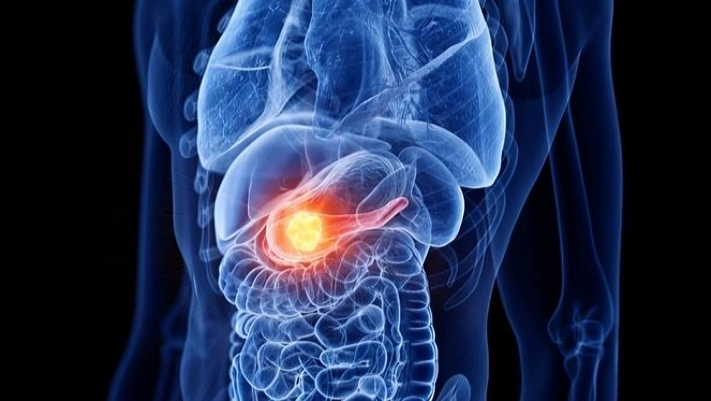 Iván González: The ESPAC4 study reveals promising results in treating pancreatic adenocarcinoma