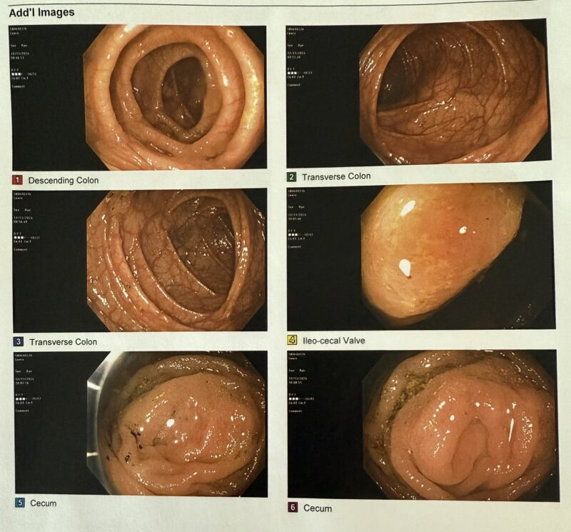 Mark Lewis: First colonoscopy done