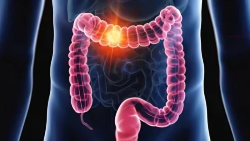 New Review on ctDNA in Early-Stage Colon Cancer by Rami Yanes et al