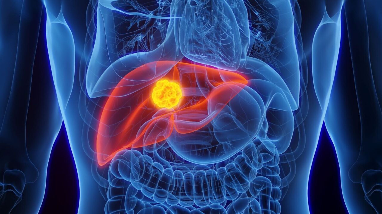 How PLT012 can Rejuvenate Antitumor Immunity to Reprogram the Immune landscape of Liver Cancer – Cancer Research Institute