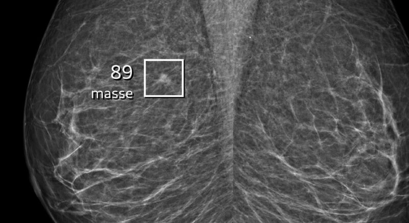 Breast cancer MRI