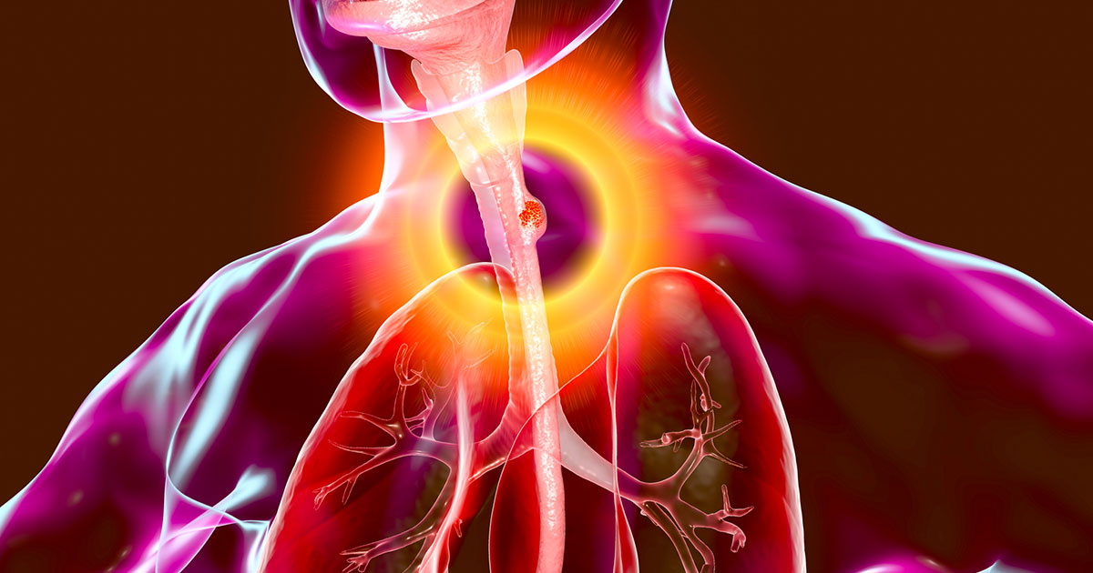 Erman Akkus: Role of PD-L1 expression in advanced esophageal SCC by Manavi Sachdeva et al.