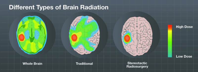 stereotactic radiotherapy 