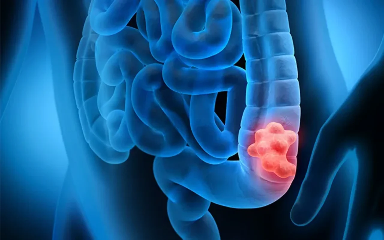 Akhil Santhosh: OrigAMI1 – The Effect of Amivantamab in Previously Treated RAS Wild Colon Cancer