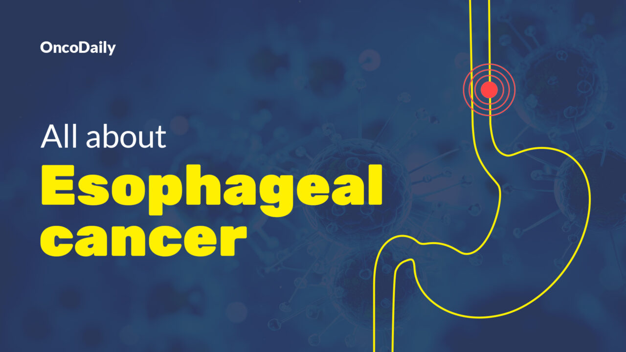 Esophageal Cancer: Symptoms, Causes, Stages, Diagnosis & Treatment