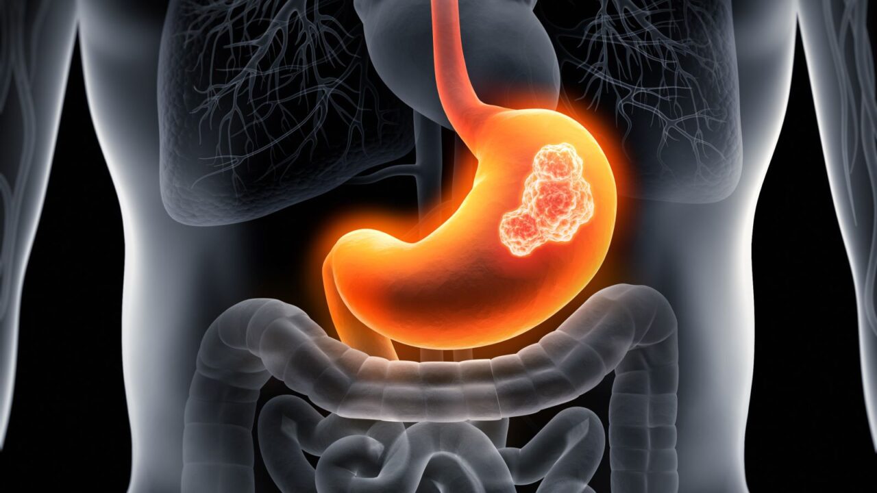 FDA has approved BeiGene’s PD-1 inhibitor for gastric or gastroesophageal junction adenocarcinoma