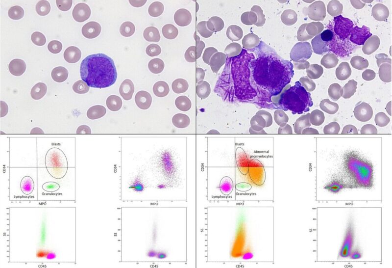 Siba El Hussein on rare presentations of Acute promyelocytic leukemia