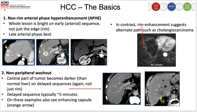 Hepatocellular Carcinoma 101 with Nina Niu Sanford