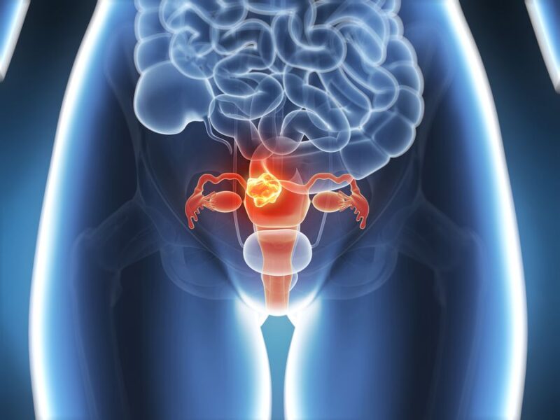 Dostarlimab Plus Chemo Earned Positive CHMP Opinion for Expanded Indication in Advanced Endometrial Cancer