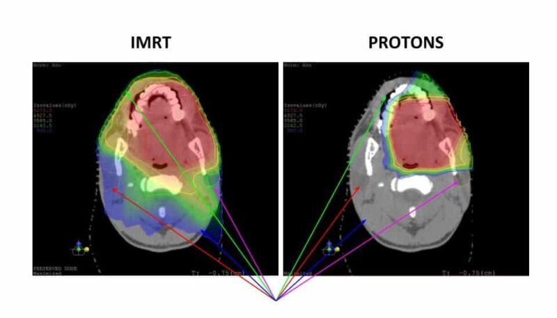 proton radiotherapy 