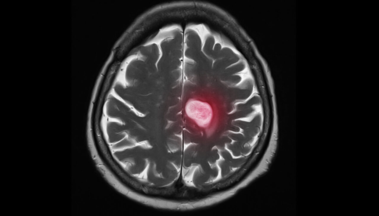 The role of ADCs in the treatment of patients with Breast Cancer Brain Metastases – Dana-Farber’s Breast Oncology Center