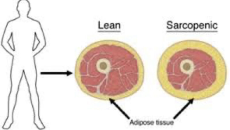 Sami (Papacek) Mansfield: Cancer and an ignored risk - sarcopenic obesity.