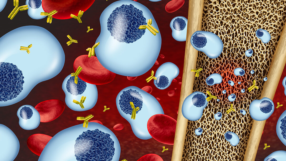 Mechanisms for resistance to BCMA-targeted immunotherapies in multiple myeloma