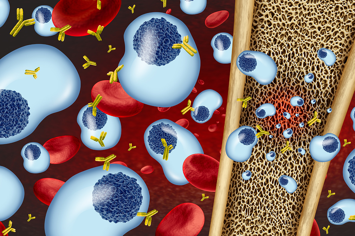 Study exploring the role of the lncRNA NEAT1 as an attractive therapeutic candidate in multiple myeloma