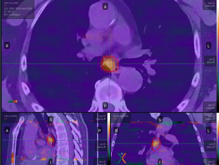 UTSW Radiation Oncology Department has imaged its first patient using Reflexion PET with the Ga68-PSMA-11 tracer