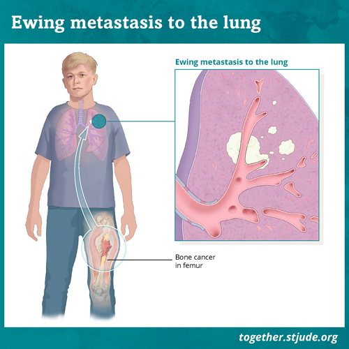 Ewing Sarcoma: Symptoms , Causes, Stages, Diagnosis and Treatment