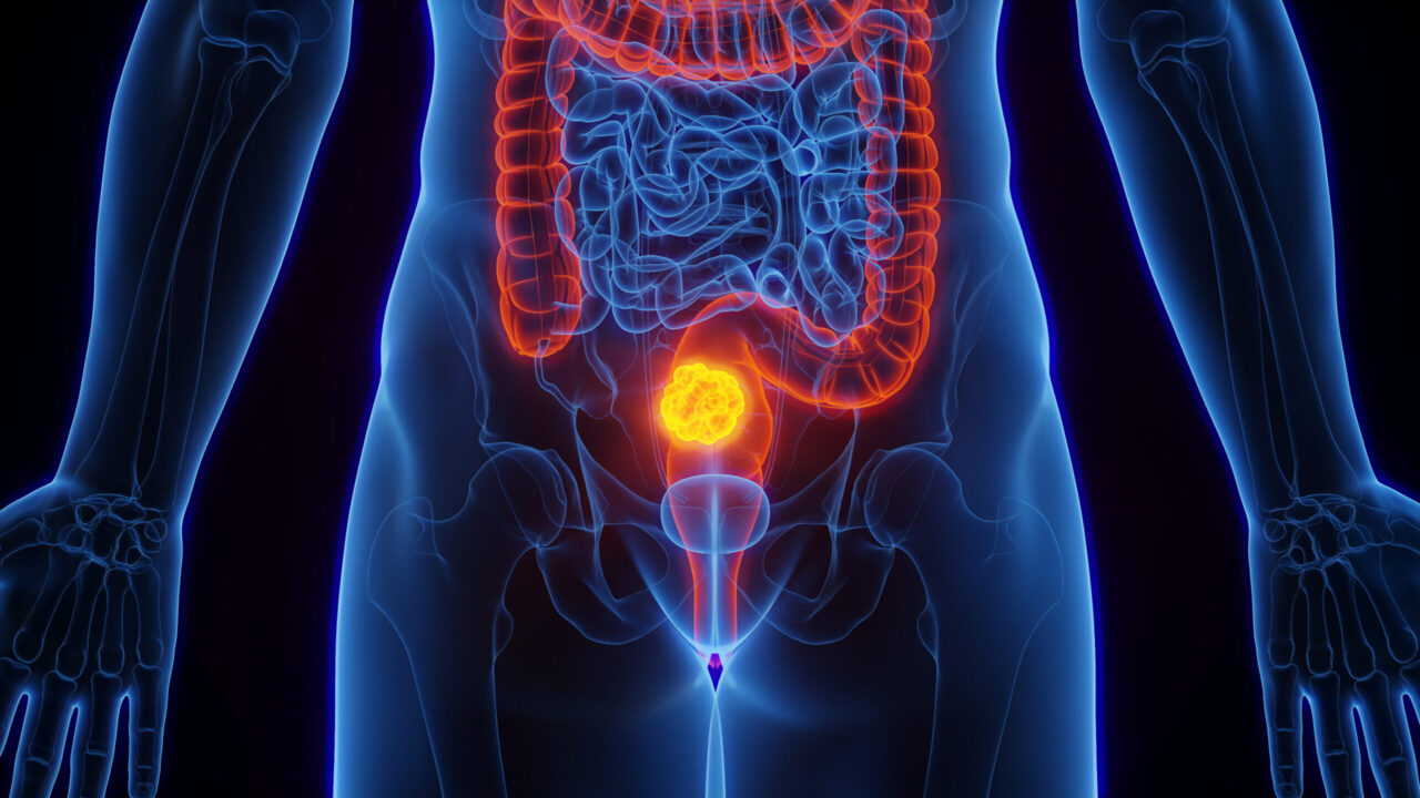 Akhil Santhosh: FOWARC trial questions the role of RT in rectal cancer