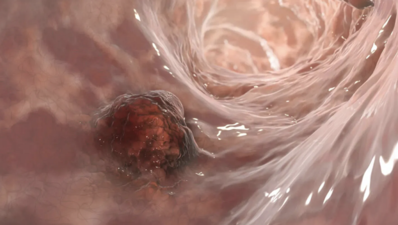 Salmonella to be used in bowel cancer therapies