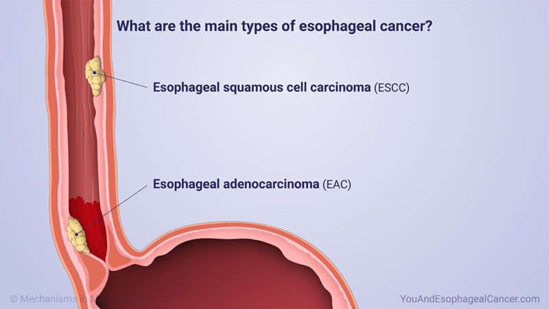 main type of esophageal cancer