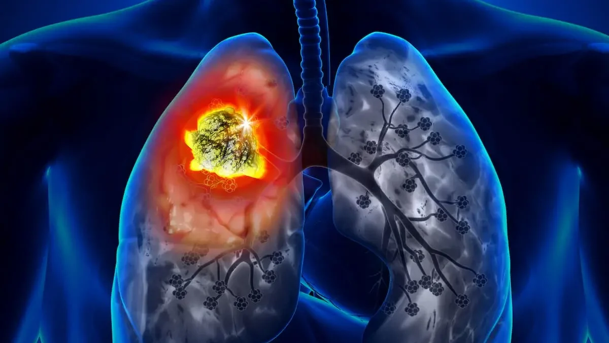 Lung Cancer in Young Chinese Adults – Asian Fund for Cancer Research