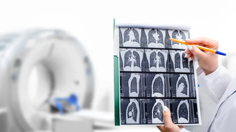 Estela Rodriguez: How many lives would be saved with lung cancer screening?