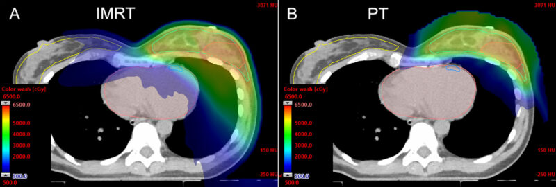 proton therapy breast cancer