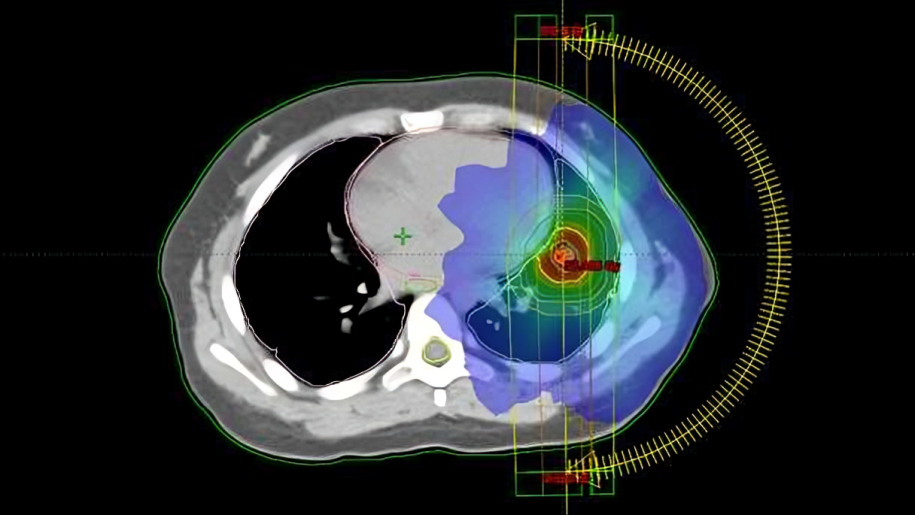 Drew Moghanaki: The largest randomized phase III trial evaluating lung SBRT