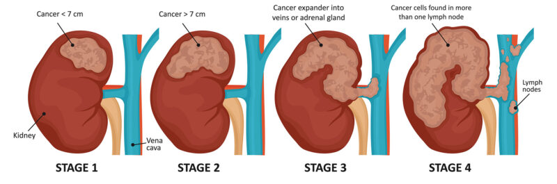 Kidney cancer