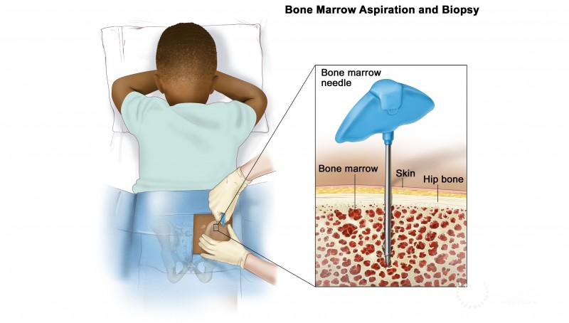 Bone Marrow Aspiration and Biopsy