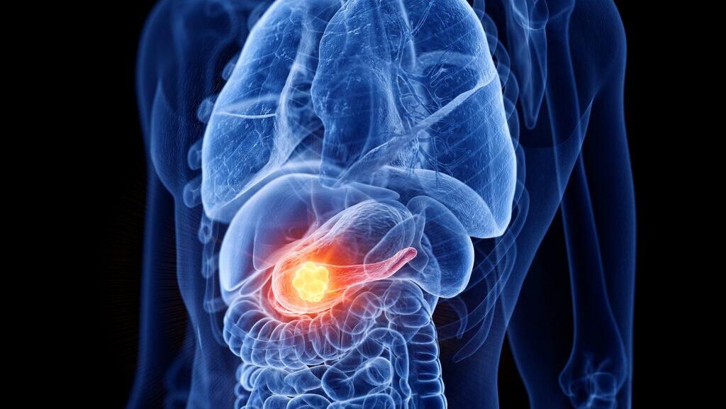 Adjuvant Gemcitabine and capecitabine in resected Pancreatic Adenocarcinoma