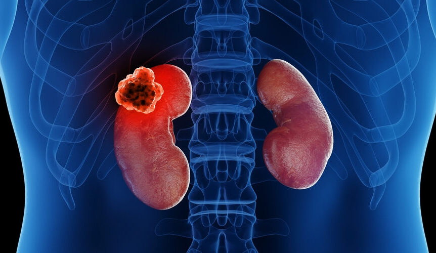 Efficacy of Treatments After Lenvatinib in Patients with Advanced Renal Cell Carcinoma