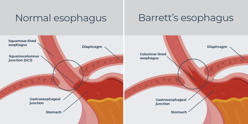 Barretts esophagus