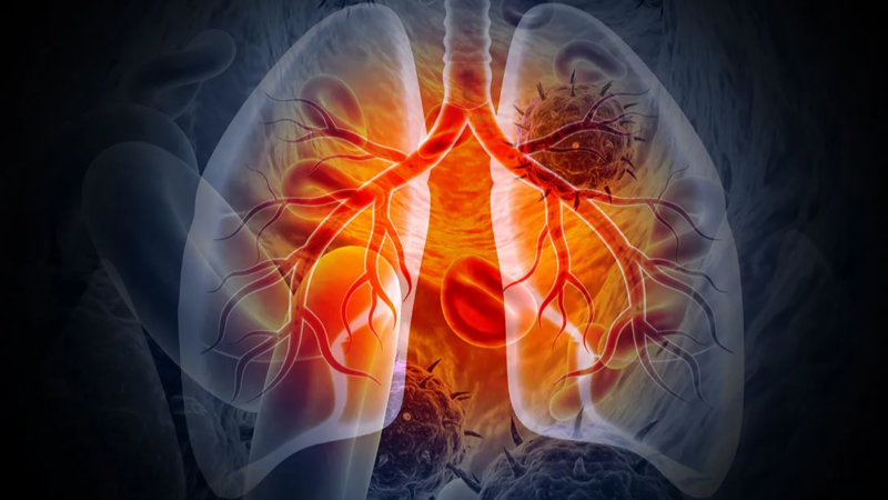 Risk Factors Linked to Lung Cancer Deaths – Sylvester Comprehensive Cancer Center