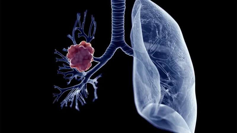 George Vlachogiannis: A major driver of morbidity and poor outcomes in advanced NSCLC