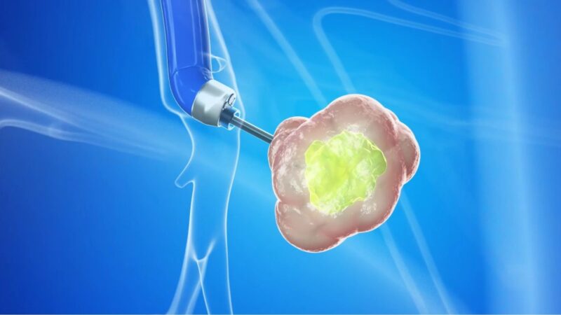 Avrum Spira: Expanded collaboration with Ankyra Therapeutics for local immunotherapy in NSCLC