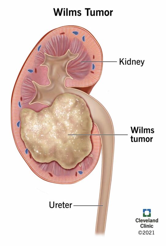 Wilms Tumor