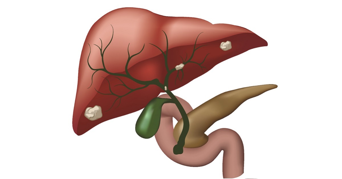 Safety and Efficacy of Toripalimab in Patients with Cholangiocarcinoma