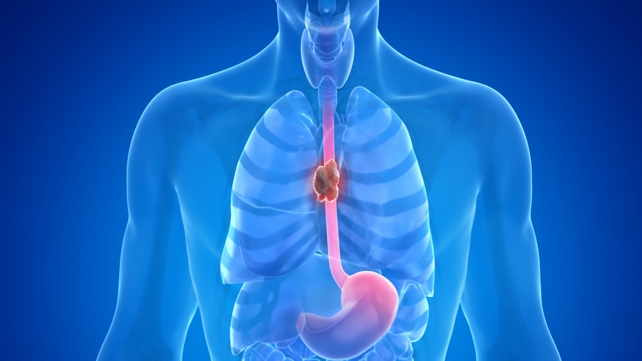 Senthil Kumar: Comprehensive Overview of First-Line Treatment for Metastatic Esophageal Cancer