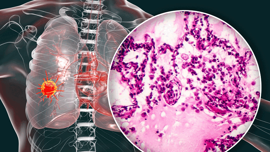 Glecirasib in KRASG12C-mutated non-small cell lung cancer by Yuankai Shi et al.