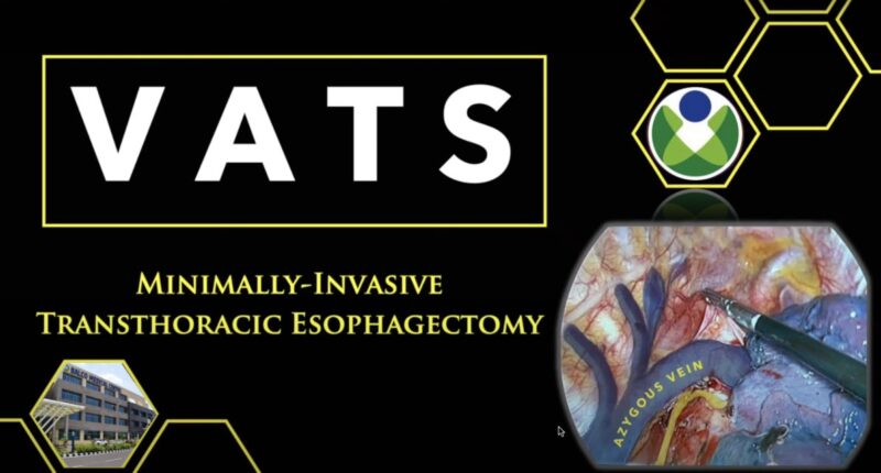 Shravan Nadkarni: VATS Transthoracic Esophagectomy