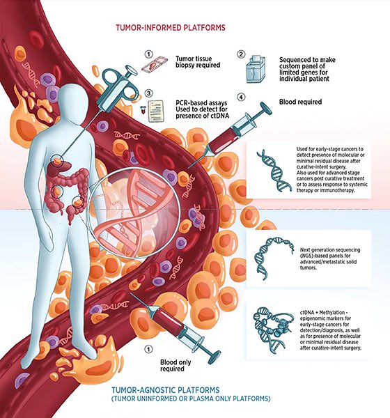 Pashtoon Kasi: Different kind of liquid biopsies in guiding care of patients with cancer