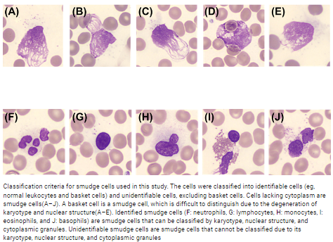 Nihar Desai: A case of elevated white cell count in a 60-year-old male