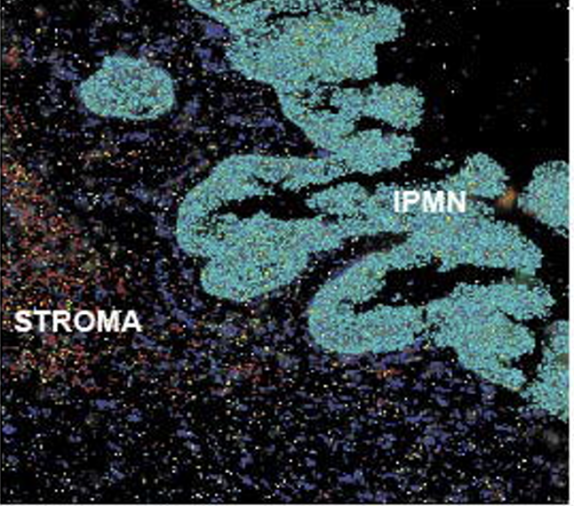 Spatial transcriptomics of Intraductal Papillary Mucinous Neoplasms, review by Anirban Maitra