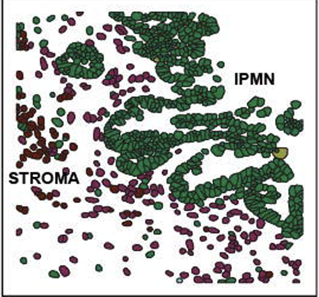 Spatial transcriptomics of Intraductal Papillary Mucinous Neoplasms, review by Anirban Maitra