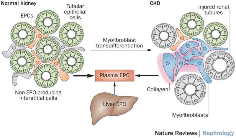 Nihar Desai: Anemia in CKD