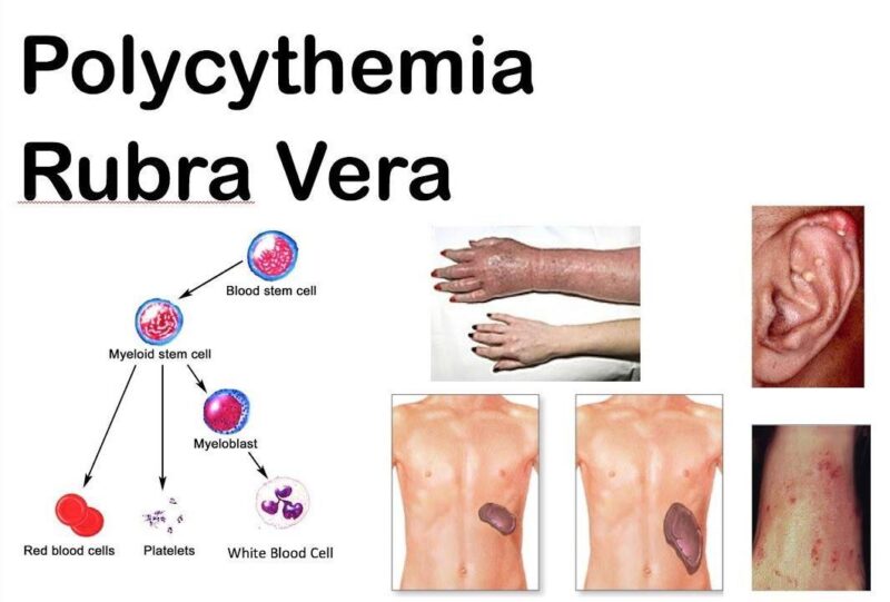 Polycythemia Vera (PV) 