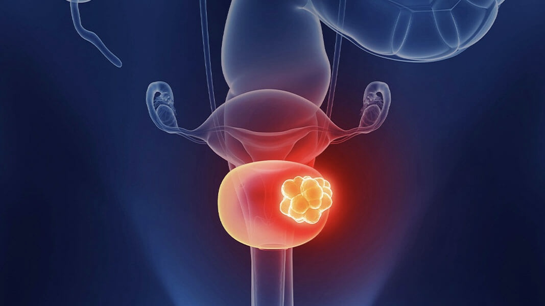 Erman Akkus: Adjuvant pembrolizumab after surgery in high risk muscle invasive bladder cancer