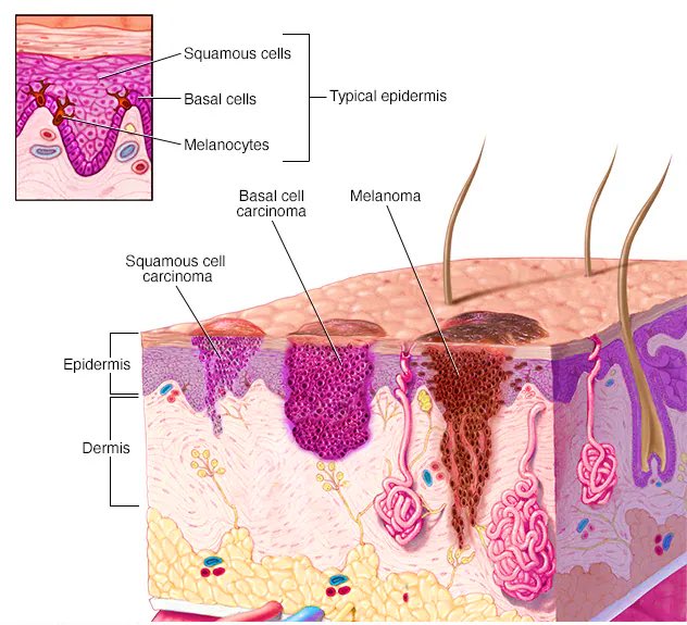 Shahrin Ahmed: Squamous cell carcinoma can be prevented long-term with the help of new immunotherapy